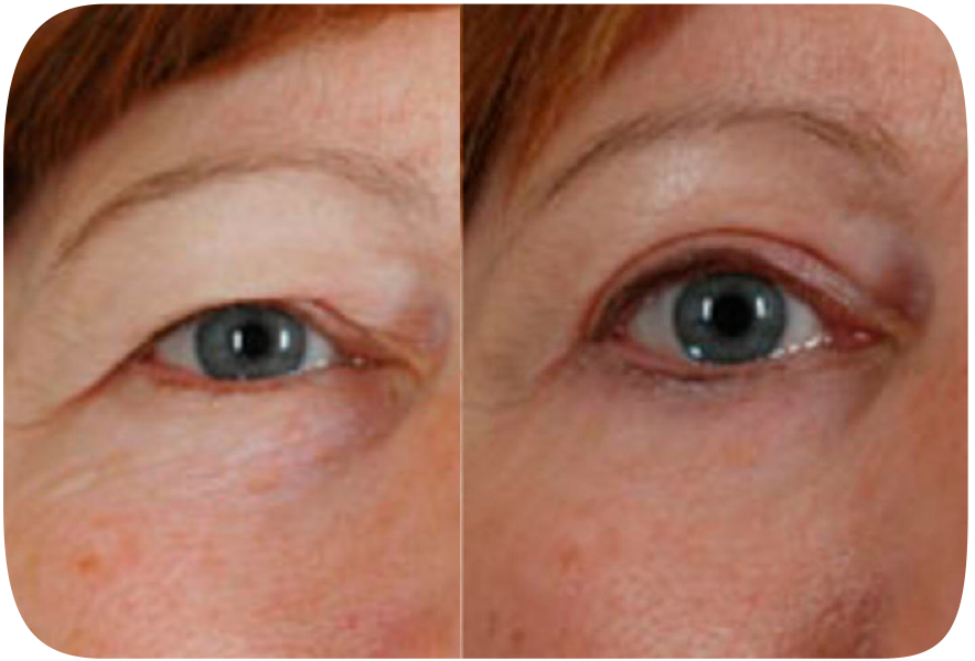Lifting de cejas