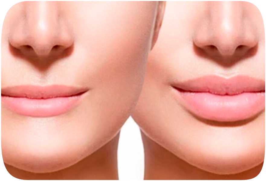 Lip lift