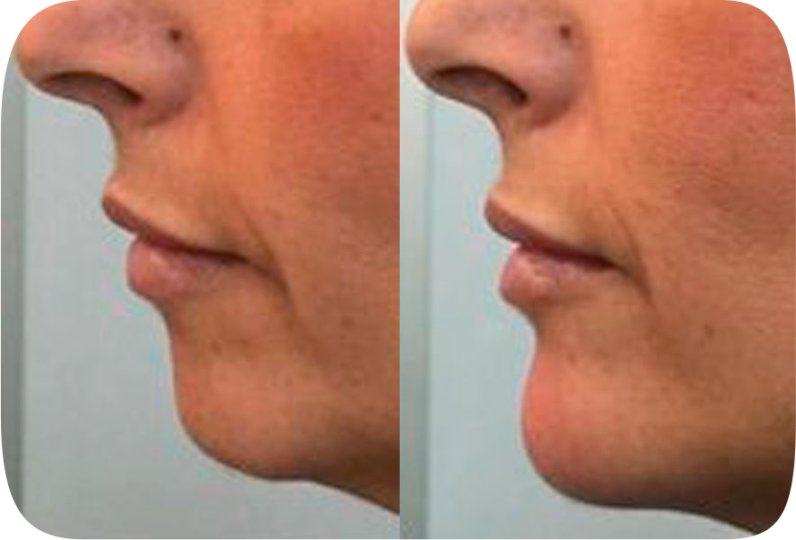 Mentoplastia