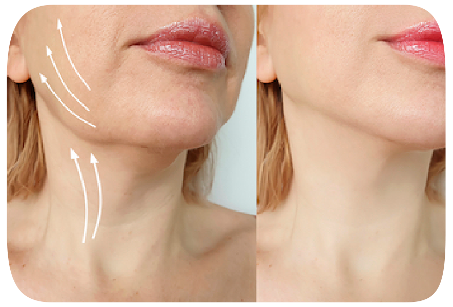 Lifting de cuello