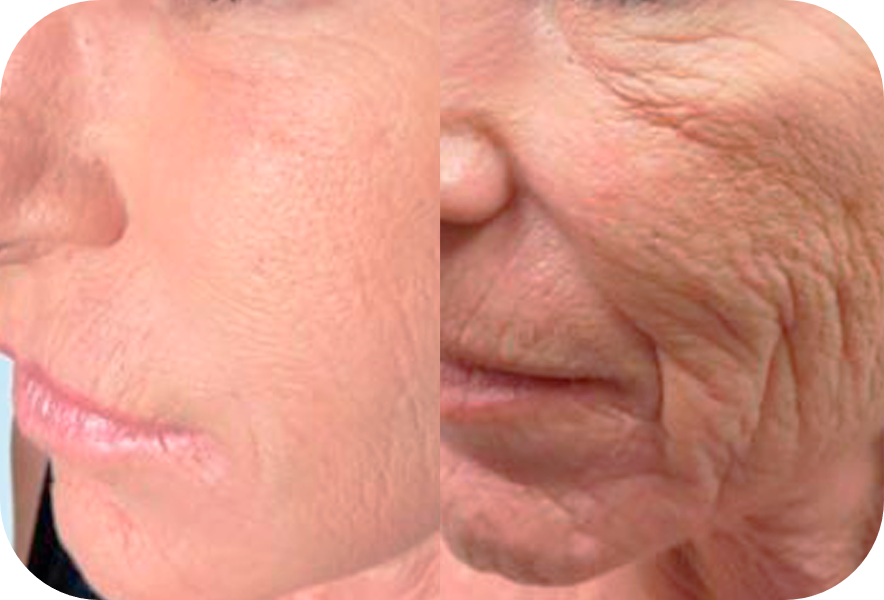 PRP facial